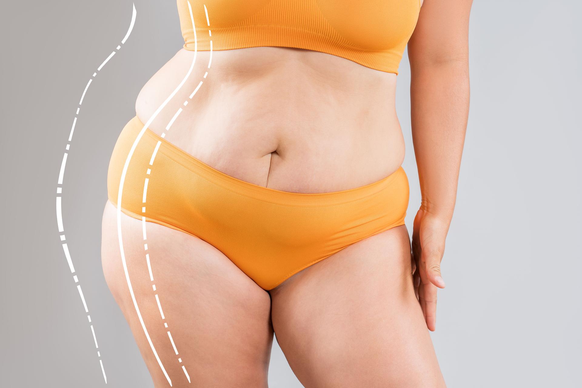 Fat woman with cellulitis, flabby belly, obesity hips and buttocks on gray background, obese female body, liposuction, plastic surgery and body positive concept with surgical lines