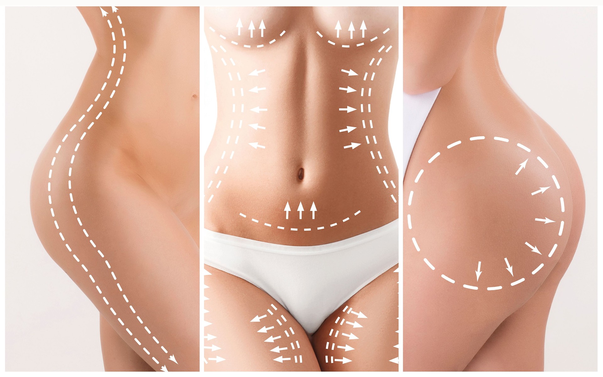 The cellulite removal plan. White markings on young woman body