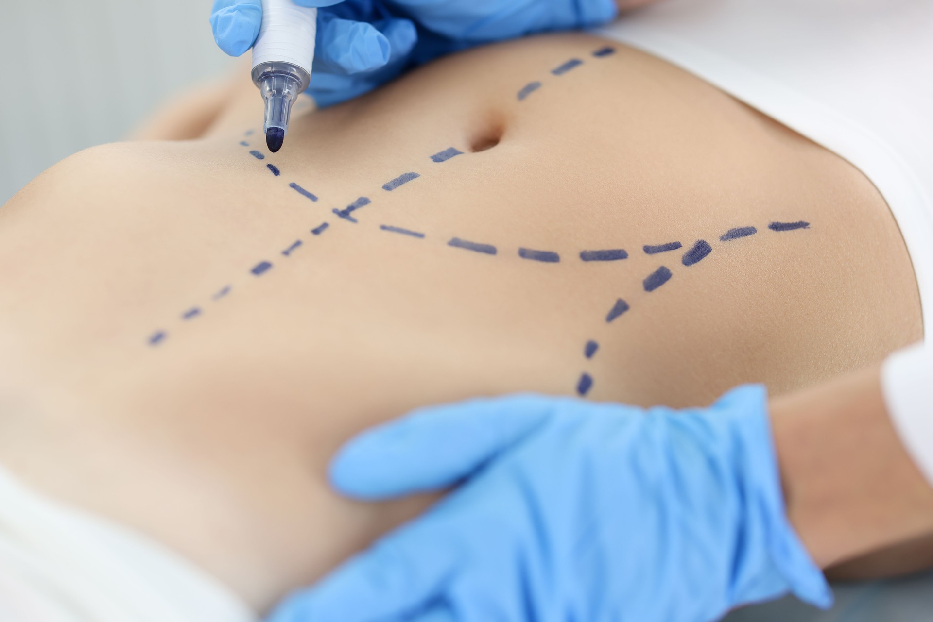 Doctor plastic surgeon drawing preoperative markings on skin of patient abdomen closeup