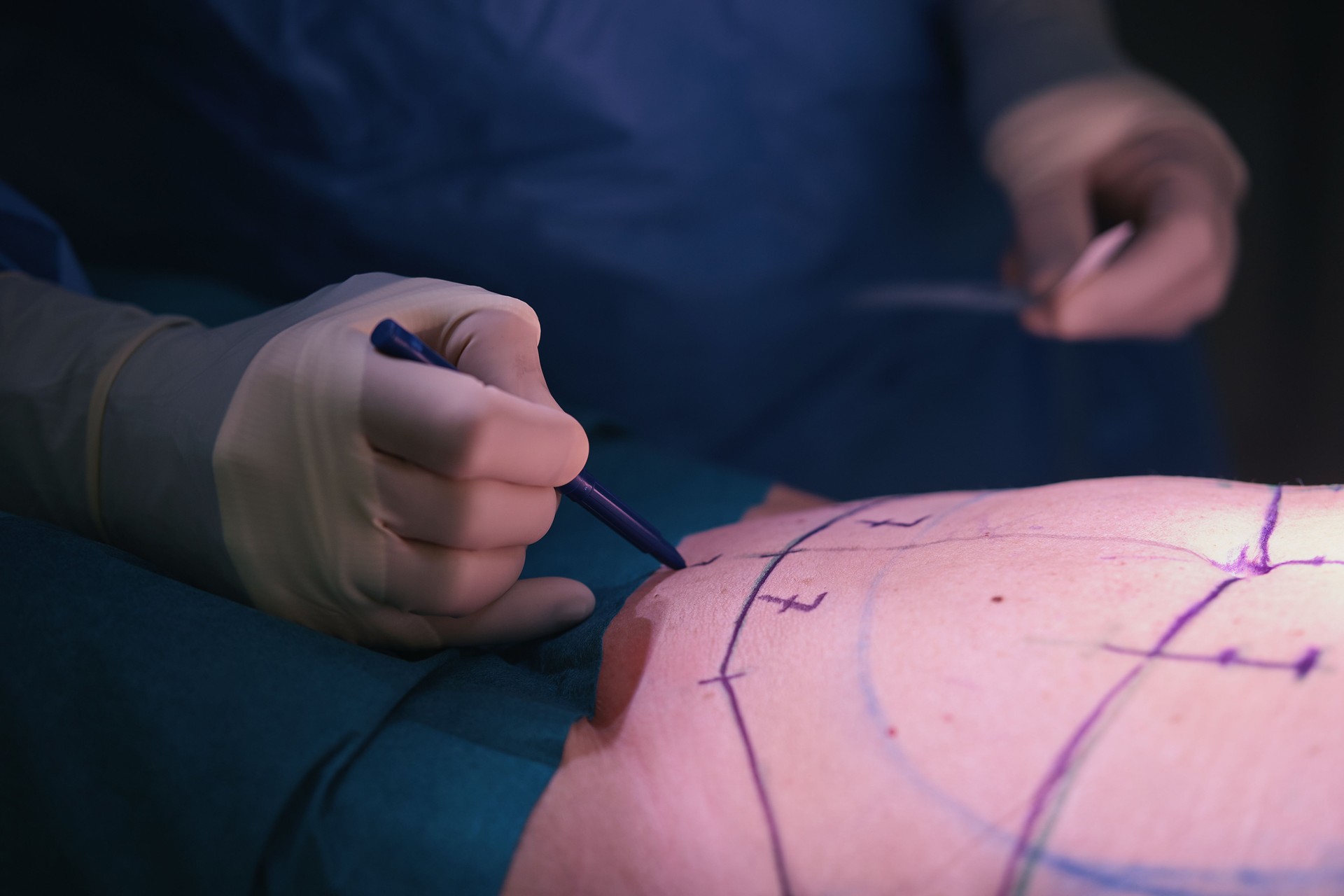 marking cutting lines for tummy tuck