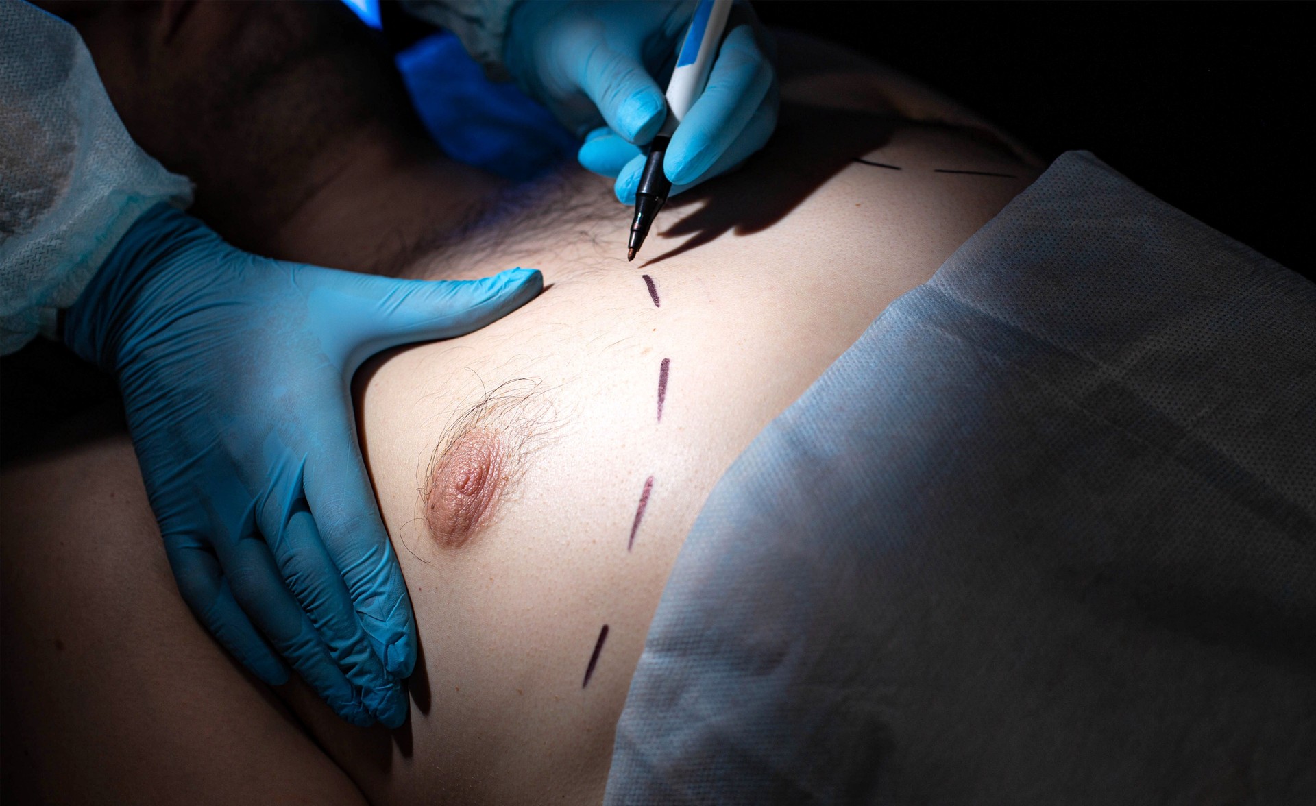 Plastic surgeon doctor prepares for breast reduction surgery on a man, close-up. Liposuction