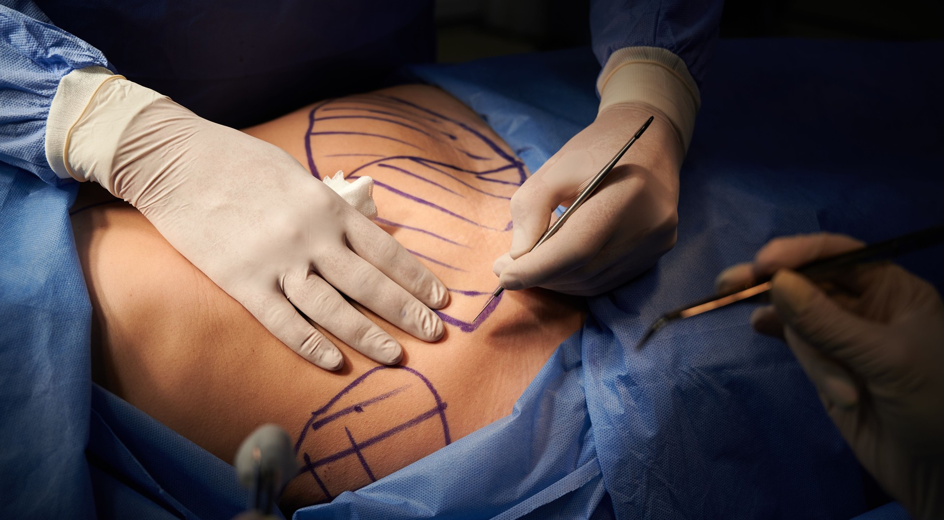 Doctor hands performing plastic surgery in operating room.